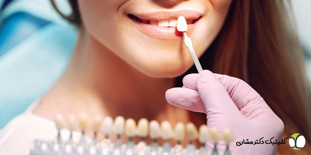 کامپوزیت دندان در پاسداران