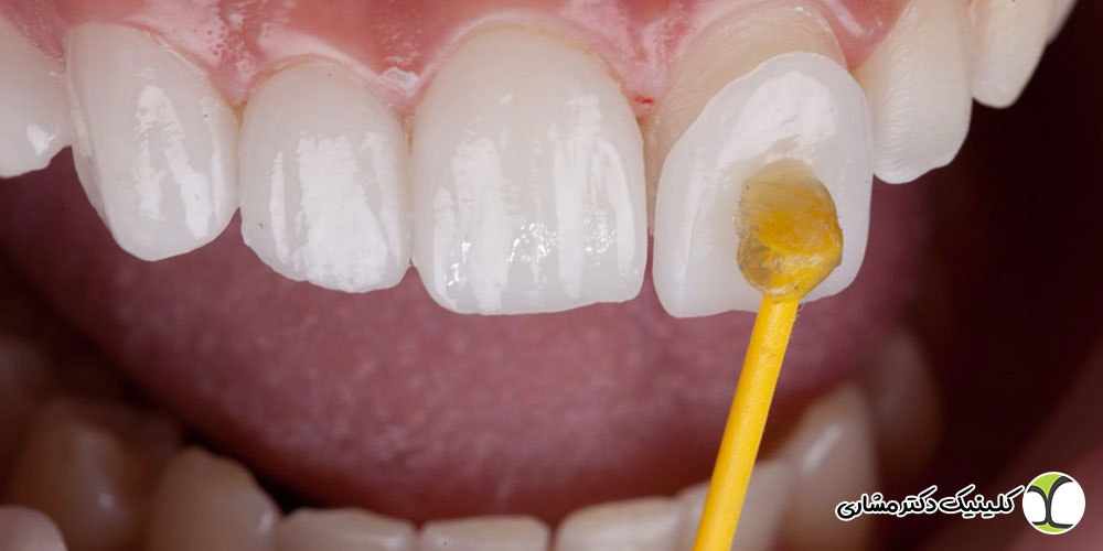 لمینت دندان در پاسداران