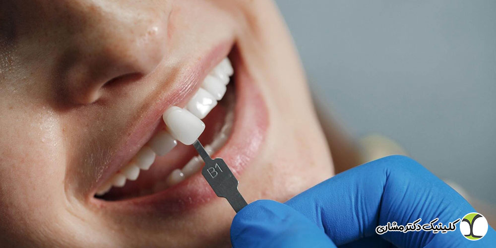 لمینت دندان در پاسداران