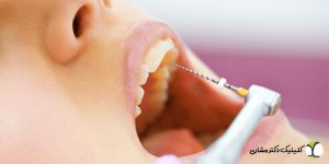 درمان ریشه دندان در تهران