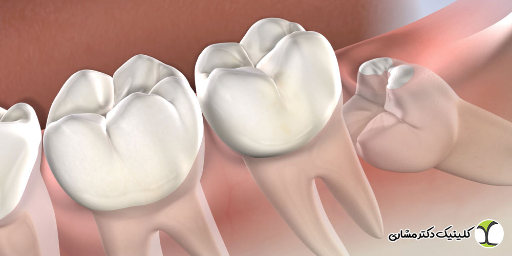 جراحی دندان عقل