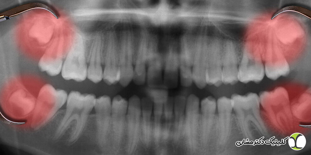 جراحی دندان عقل