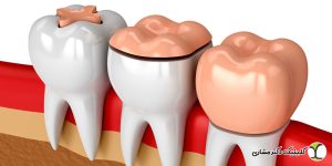 اینله و آنله