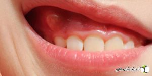 چه چیزی باعث کیست دندان می شود