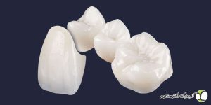 روکش تمام سرامیکی