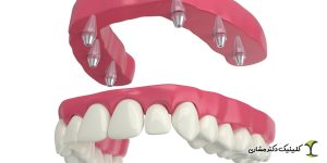 مزایای کاشت ایمپلنت نسبت به دندان مصنوعی