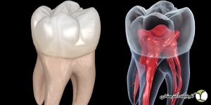 علائمی که نشان می دهند به درمان ریشه دندان نیاز دارید
