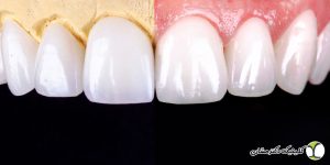 مقایسه کامل لمینت سرامیکی و کامپوزیتی