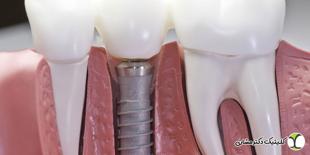 مراقبت های بعد از ایمپلنت دندان