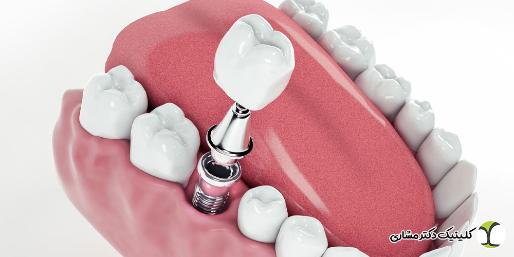 مراقبت های بعد از ایمپلنت دندان