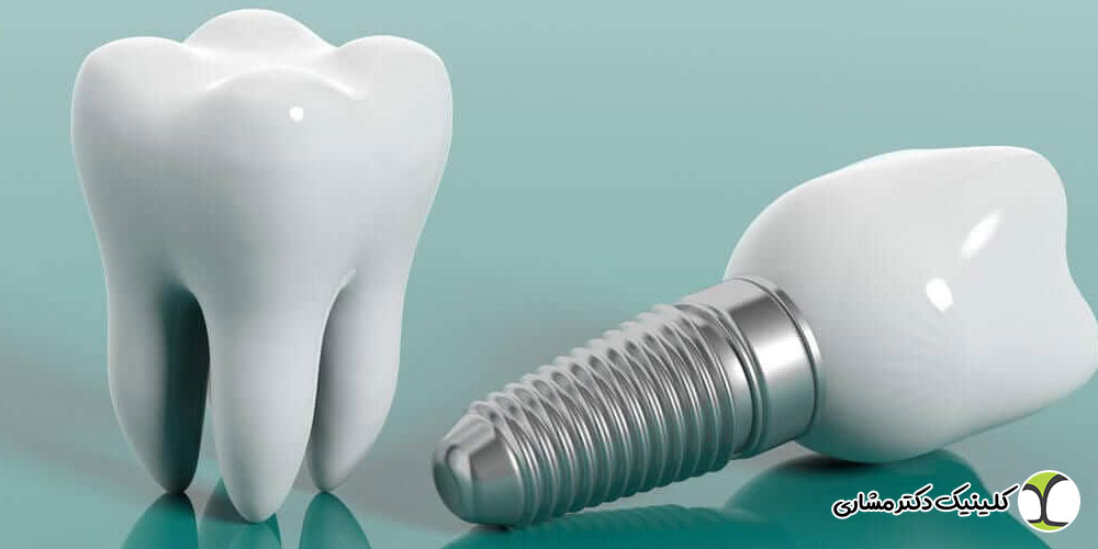 مراقبت های بعد از ایمپلنت دندان
