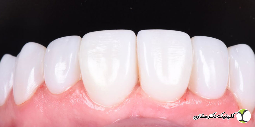 طول عمر کامپوزیت دندان چقدر است