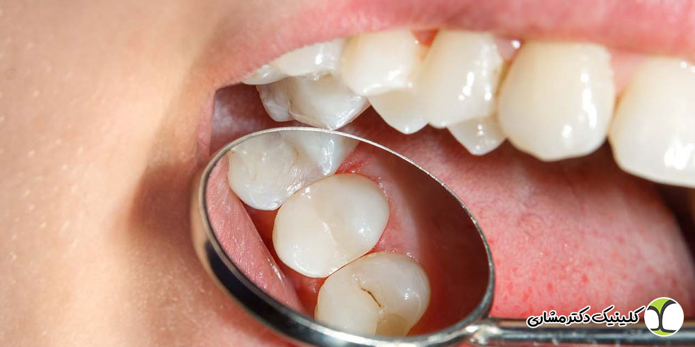 طول عمر کامپوزیت دندان چقدر است