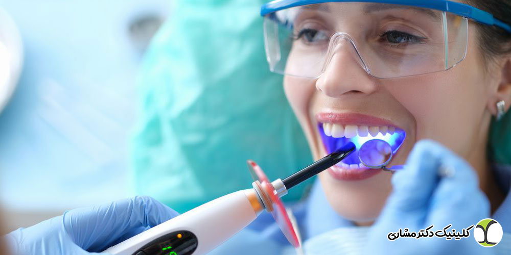 طول عمر کامپوزیت دندان چقدر است