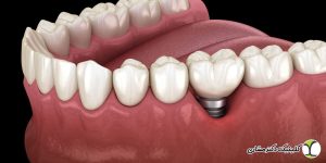 کاندید مناسب برای ایمپلنت دندانی