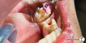 درمان ریشه دندان شکسته