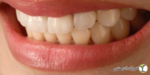 چه افرادی نمی توانند لمینت دندان انجام دهند