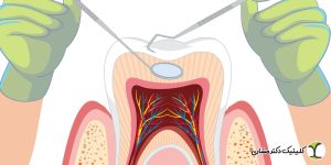 جراحی های اصلاحی ریشه