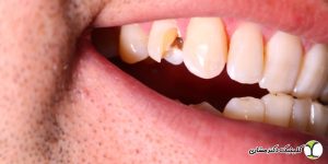 همه دندان های شکسته نیاز به درمان ریشه دارند