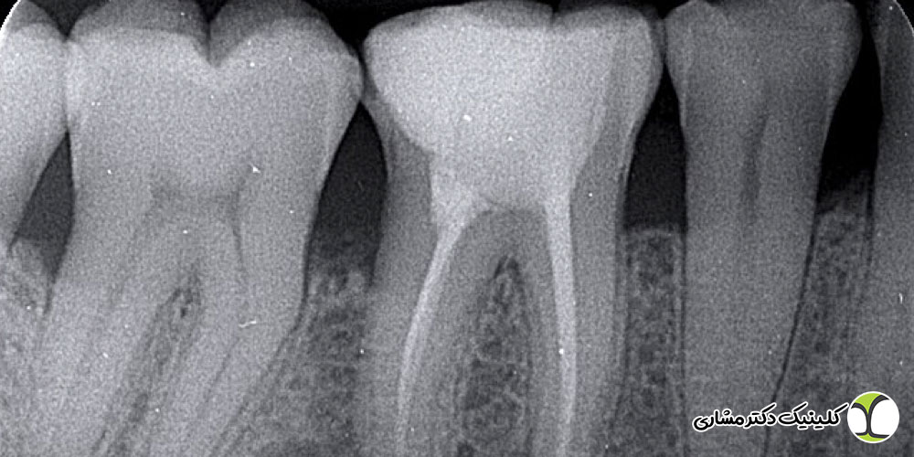بسته بودن کانال در حین عصب‌ کشی