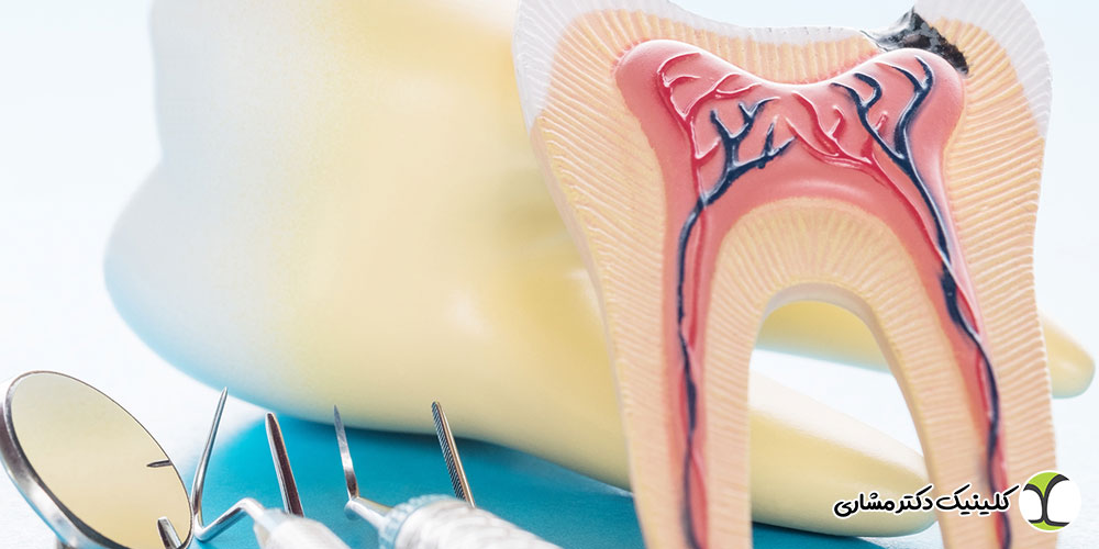 بسته بودن کانال در حین عصب‌ کشی