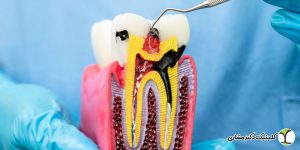 بسته بودن کانال در حین عصب‌ کشی