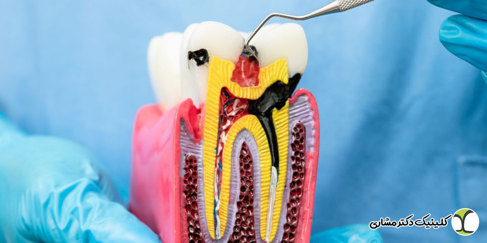 بسته بودن کانال در حین عصب‌ کشی