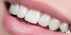 مقایسه کامپوزیت ونیر و بلیچینگ