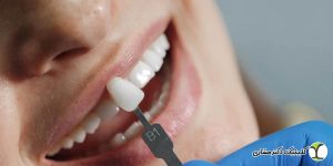 آیا لمینت باعث آسیب به مینای دندان می شود