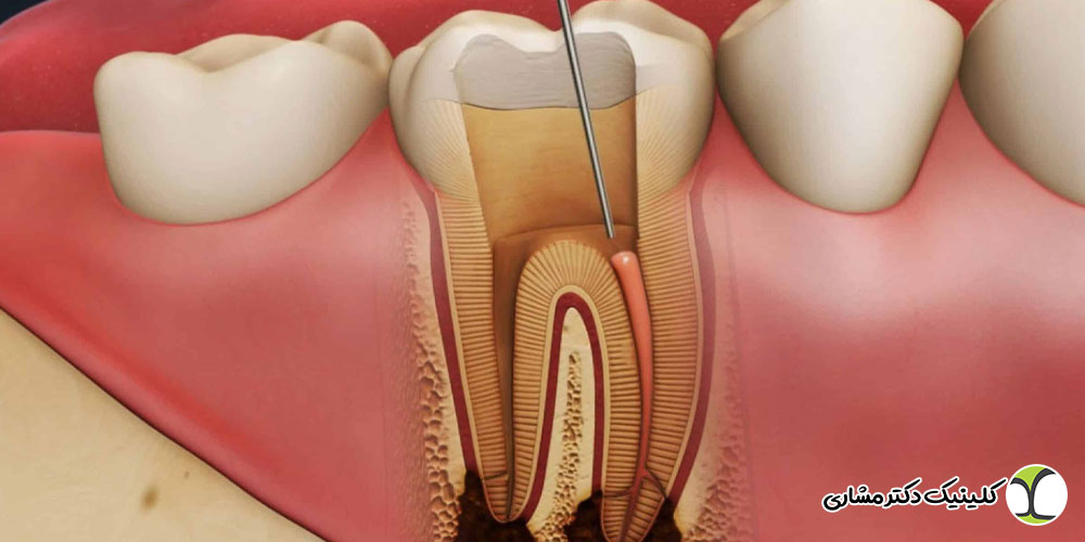 تشخیص درمان مجدد ریشه