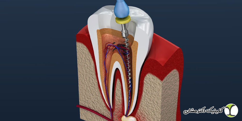 تشخیص درمان مجدد ریشه