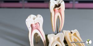 درمان ریشه دندان در یک جلسه یا چند جلسه