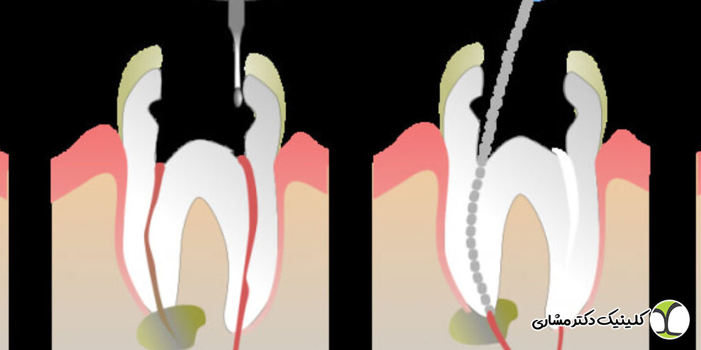 درمان عفونت ریشه چقدر طول می‌کشد