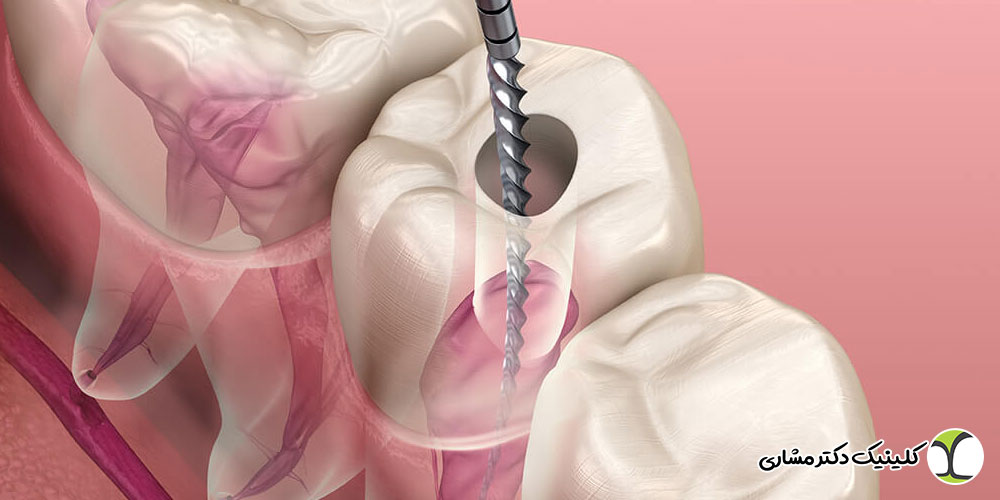 درمان عفونت ریشه چقدر طول می‌کشد
