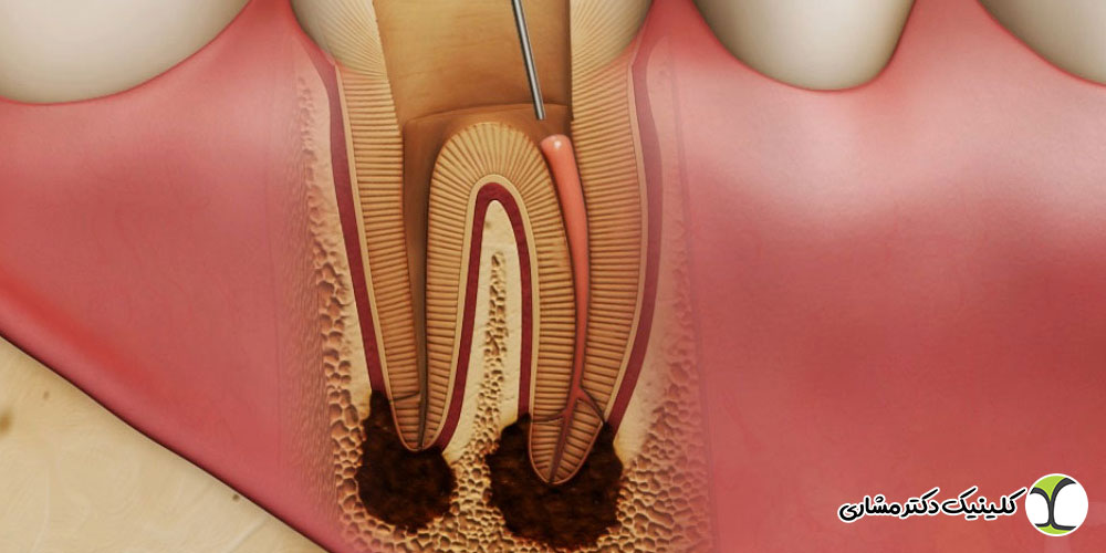 درمان عفونت ریشه چقدر طول می‌کشد