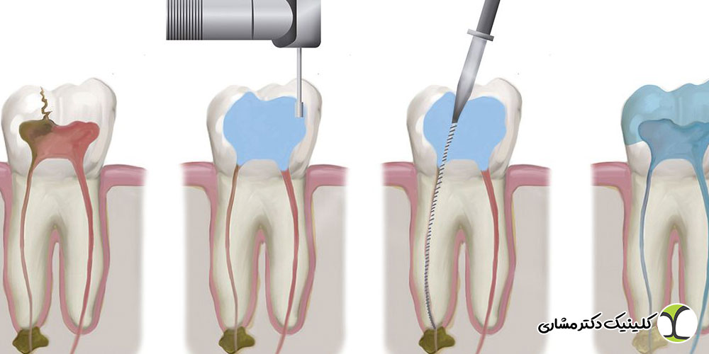 عفونت دندان عصب کشی شده