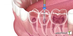 عفونت دندان عصب کشی شده