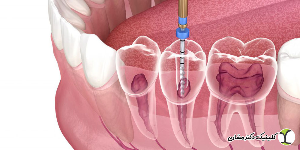 عفونت دندان عصب کشی شده