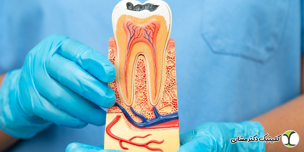 عفونت دندان عصب کشی شده