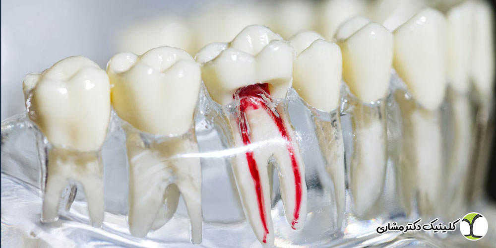 آیا تمام دندان‌ ها قابلیت درمان ریشه دارند