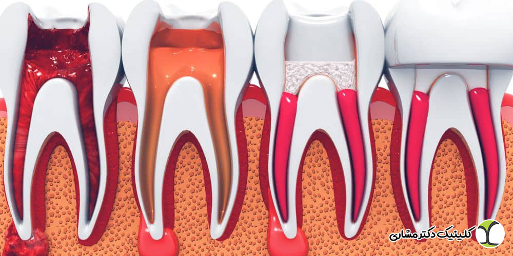 آیا تمام دندان‌ ها قابلیت درمان ریشه دارند