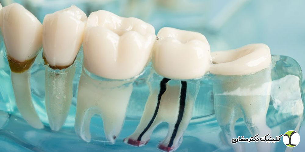 عوارض عدم درمان عفونت نوک ریشه دندان