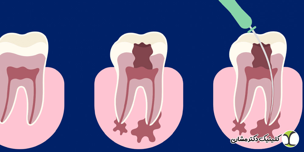 عوارض عدم درمان عفونت نوک ریشه دندان