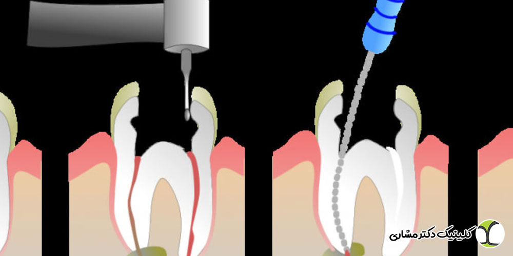 عوارض عدم درمان عفونت نوک ریشه دندان