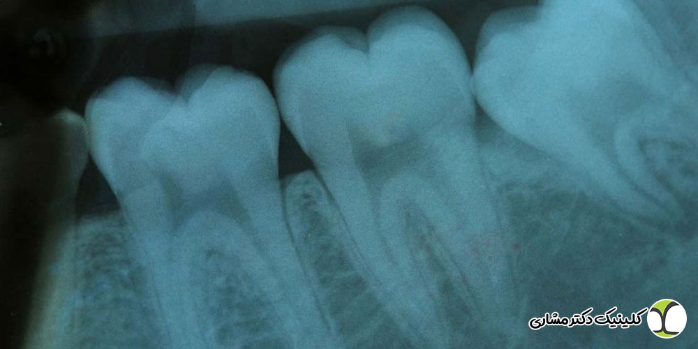 تشخیص عفونت ریشه دندان با رادیوگرافی