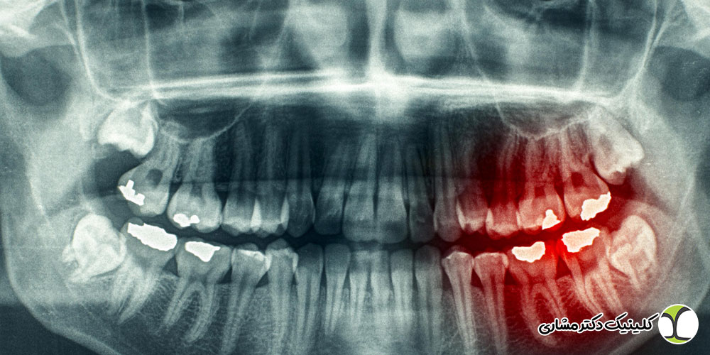 تشخیص عفونت ریشه دندان با رادیوگرافی