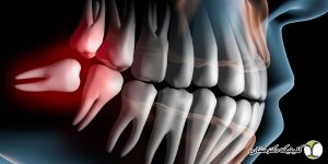 جراحی دندان عقل نهفته روی عصب