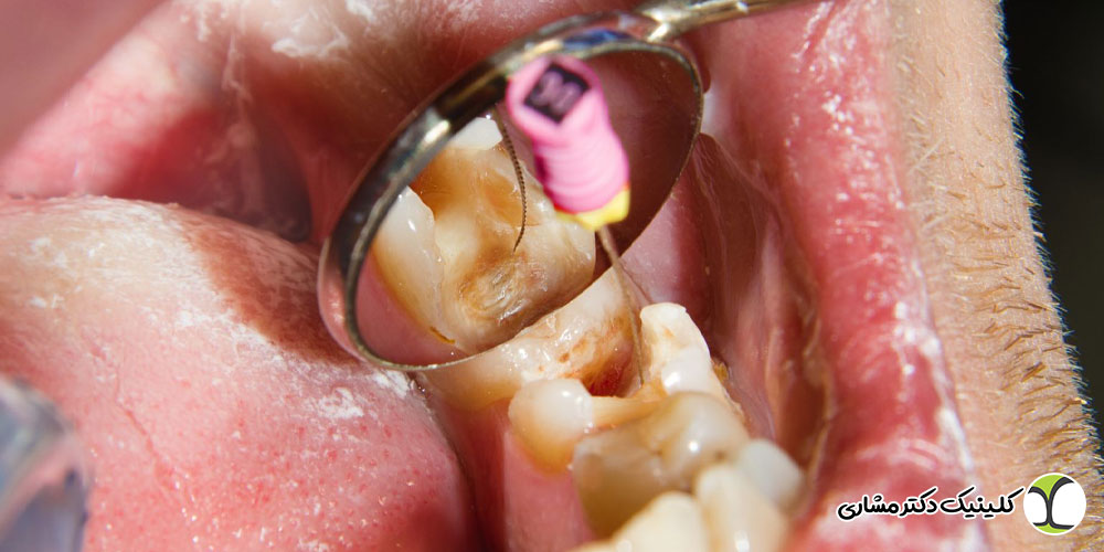 خطرات درمان ناقص ریشه دندان