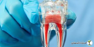 خطرات درمان ناقص ریشه دندان