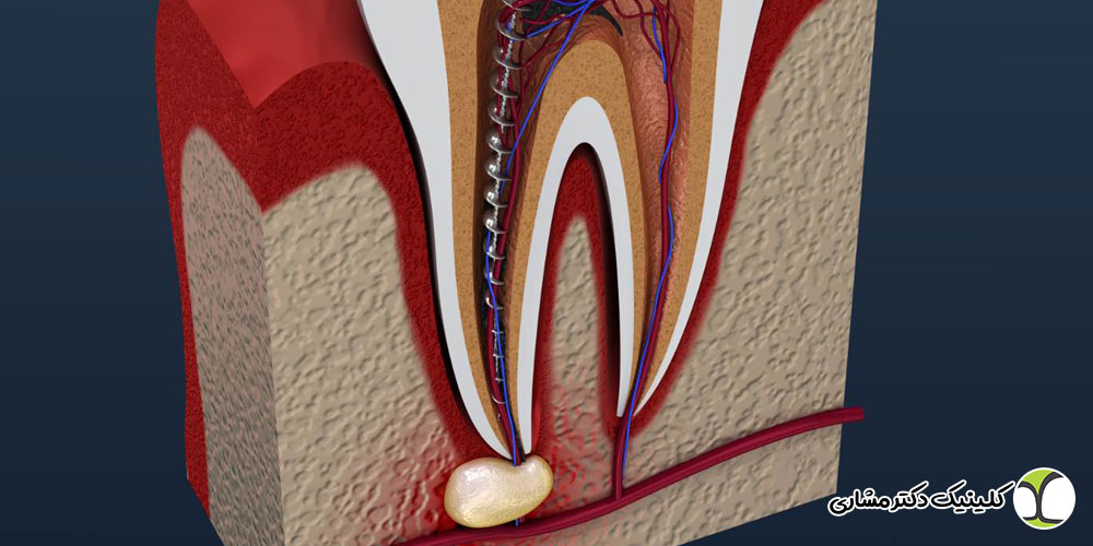 علائم نیاز به درمان ریشه دندان